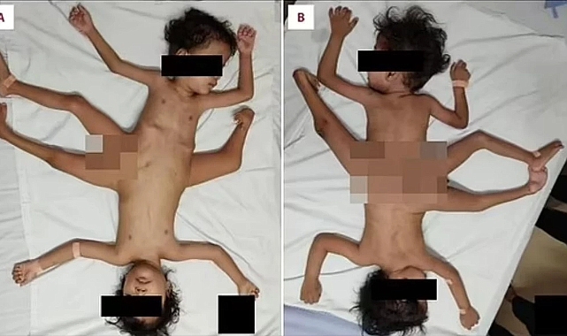 Endonezya'da üç bacağı, dört kolu olan siyam ikizler dünyaya geldi