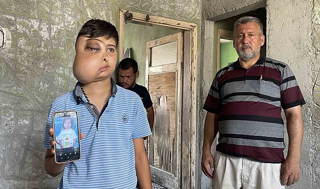 Enes'in tek isteği  tedavi olursa ilk olarak aynaya bakarak gülümsemek