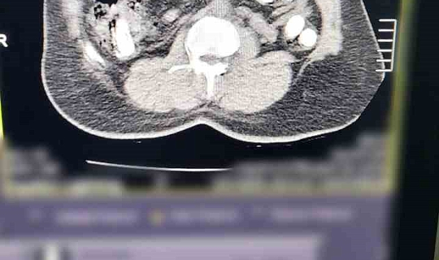 Mide ve bağırsağından 88 kapsül halinde 974 gram uyuşturucu madde ele geçirildi