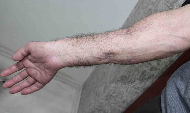 İş kazalarında uzuvları kopan hastalar, yeniden hayata tutundu