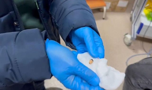 Kopya düzeneği, Hastanede operasyonla çıkartıldı