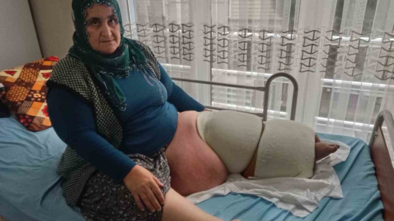 Fil hastalığı bacağını 100 kilo yaptı, tedavisinin devamı için destek bekliyor
